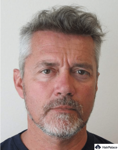 second hair transplant results